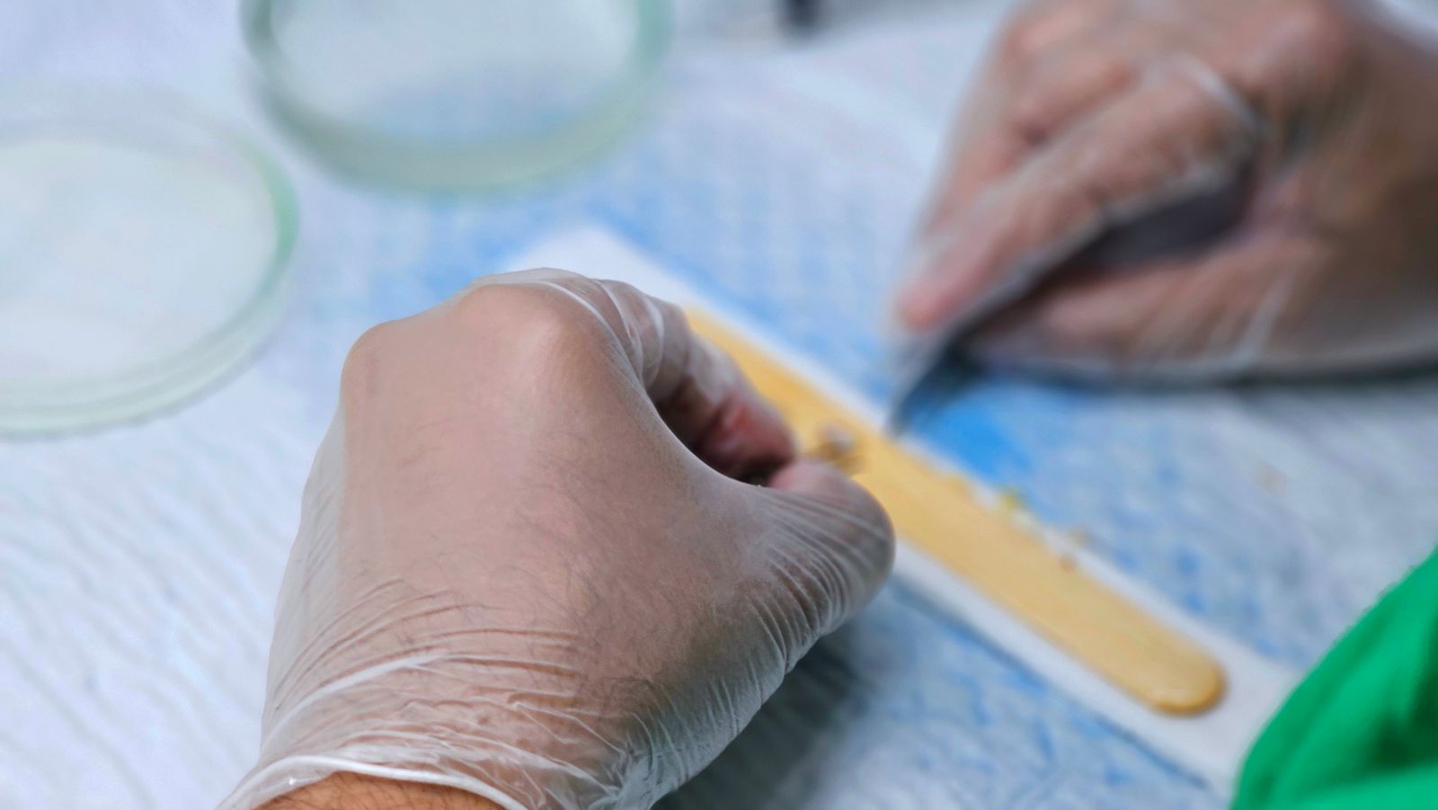 Hårtransplantation koster fra 35.000 kr. afhængigt af antallet af hårsække